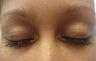 Latisse