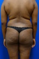 Brazilian Butt Lift
