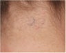 Tattoo Removal