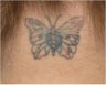 Tattoo Removal