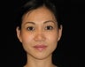 Otoplasty (Ears)