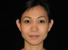 Otoplasty (Ears)