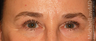 Eye Bag Surgery