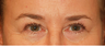 Eye Bag Surgery