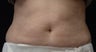 Coolsculpting