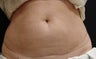 Coolsculpting