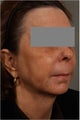 60 year old female 1.5 years after Smart Lipo of her neck and jaw line. Also loss of volume in her cheeks.