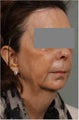 60 year old female 1.5 years after Smart Lipo of her neck and jaw line. Also loss of volume in her cheeks.