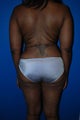 Liposuction of Back