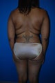 Liposuction of Back