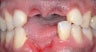 Male Before/After Dental Implants
