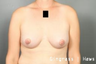 Breast Lift