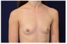 Breast Augmentation