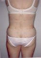 Tumescent Liposuction of the Flanks