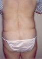 Tumescent Liposuction of the Flanks