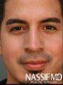 Hispanic Revision Rhinoplasty