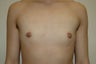 Transgender female to male. Incision around areola.