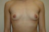 Transgender female to male. Incision around areola.
