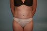 Abdominoplasty