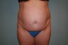 Abdominoplasty