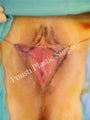 Labial Reduction