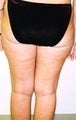 Female patient who underwent a thigh lift
