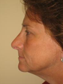 Nose Surgery