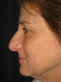 Nose Surgery