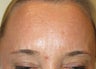 54 year-old female treated with Botox for frown lines