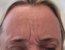 54 year-old female treated with Botox for frown lines