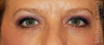 Eye Bag Surgery