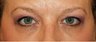 Eye Bag Surgery
