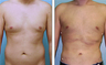 Liposuction Before & After