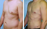 Liposuction Before & After