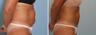 Vaser Lipo Abdomen