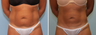 Vaser Lipo Abdomen