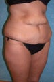Circumferential Body Lift with Buttock Augmentation