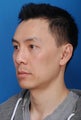 Asian Rhinoplasty