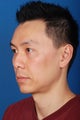 Asian Rhinoplasty