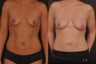 Fat Transfer breast enhancement