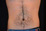 CoolSculpting to Lower abdomen
