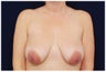 Breast lift