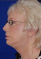 Neck Lift