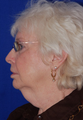 Neck Lift