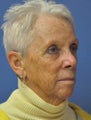 Basal cell carcinoma MOHs surgery - MOHs Reconstruction