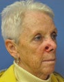Basal cell carcinoma MOHs surgery - MOHs Reconstruction