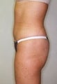 Female patient who underwent a thigh lift