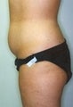 Female patient who underwent a thigh lift
