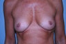 Bilateral Breast Augmentation
