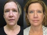 53 year old woman treated with Ulthera
